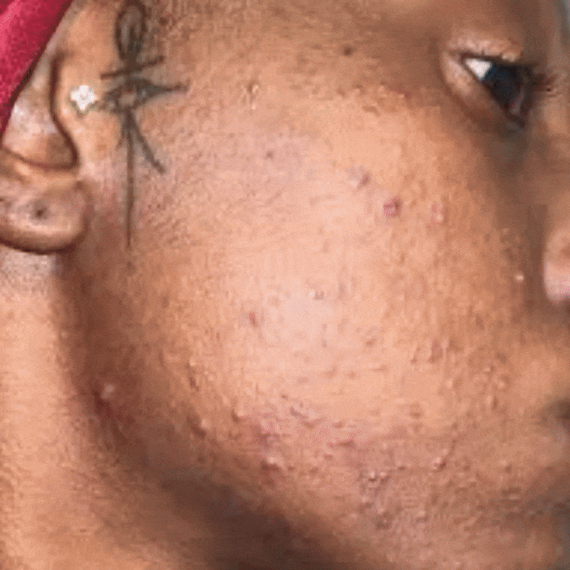 Beats Fungal Acne