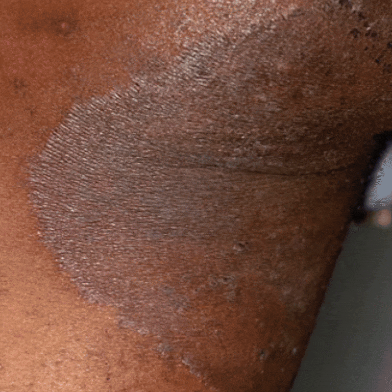 Beats Tinea Versicolor and all other fungal infections