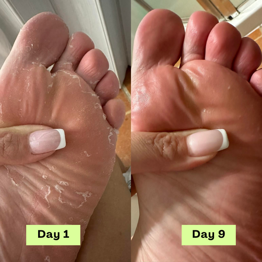 Primrose™ AntiFungal Relief Soap Bar
