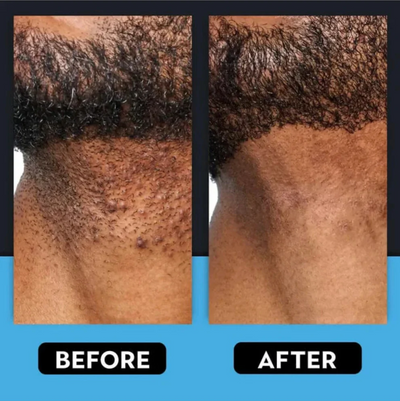 Smoothing Solution Ingrown Hair Treatment
